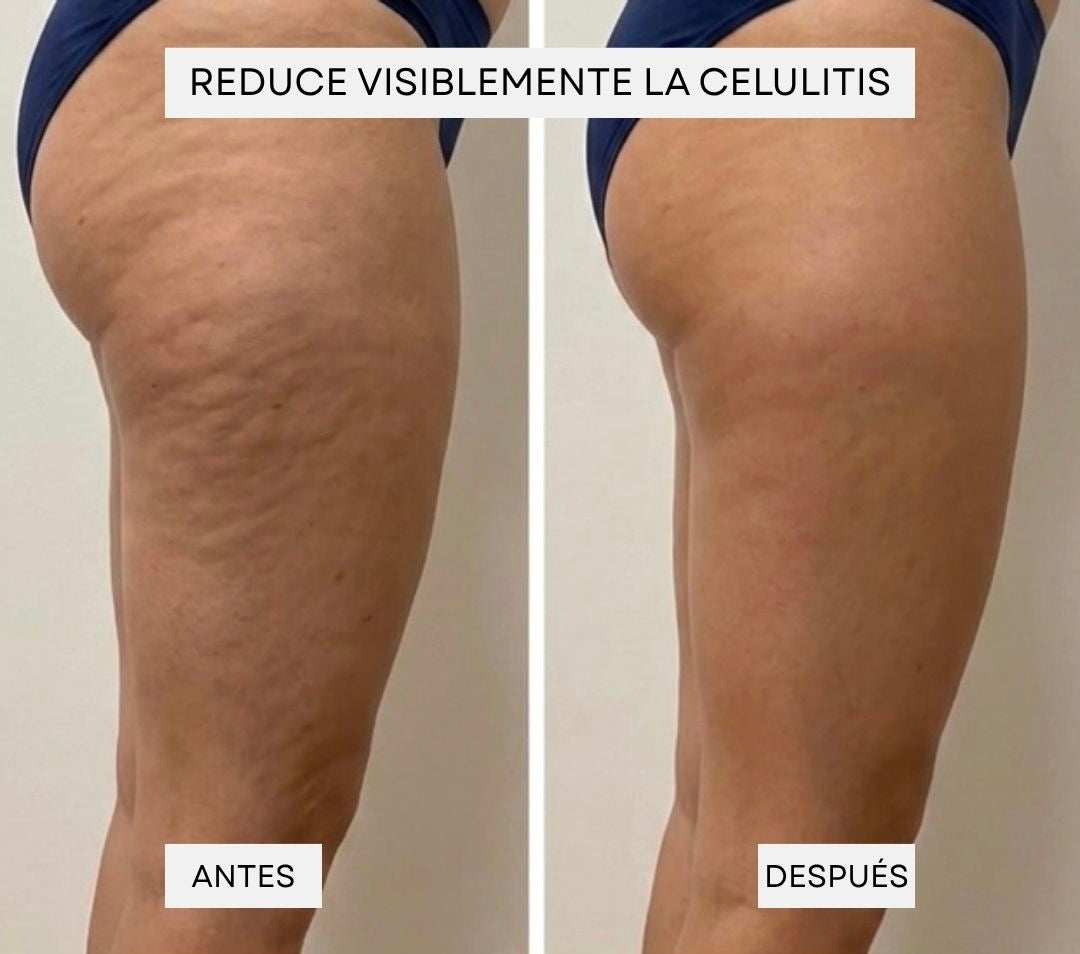 Masajeador anticelulítico