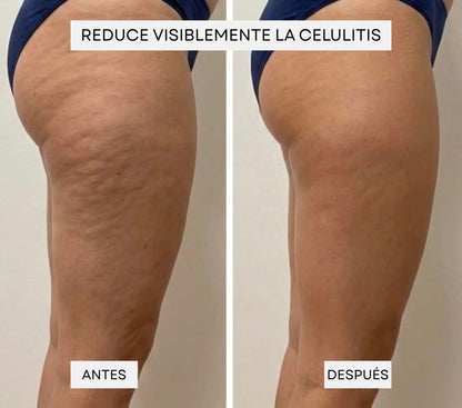 Masajeador anticelulítico